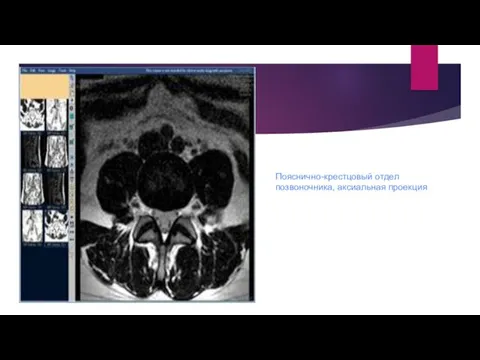 Пояснично-крестцовый отдел позвоночника, аксиальная проекция