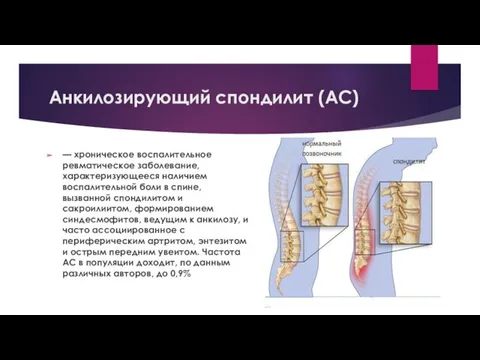 Анкилозирующий спондилит (АС) — хроническое воспалительное ревматическое заболевание, характеризующееся наличием