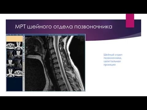МРТ шейного отдела позвоночника Шейный отдел позвоночника, сагиттальная проекция