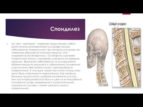 Спондилез (от греч . spondylos - позвонок) представляет собой хроническое