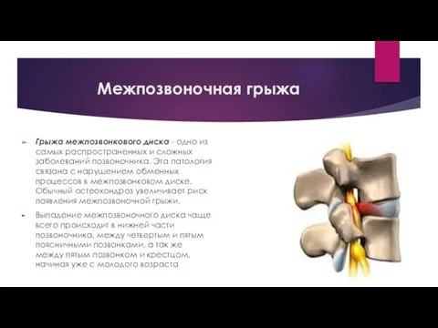 Межпозвоночная грыжа Грыжа межпозвонкового диска - одно из самых распространенных