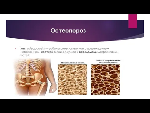 Остеопороз (лат. osteoporosis) — заболевание, связанное с повреждением (истончением) костной ткани, ведущее к переломами деформации костей.