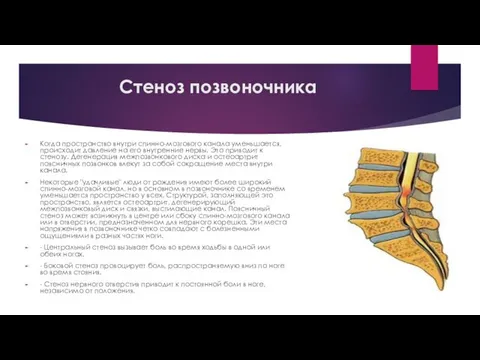 Стеноз позвоночника Когда пространство внутри спинно-мозгового канала уменьшается, происходит давление