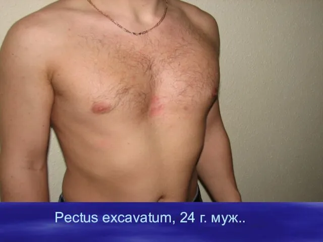 Pectus excavatum, 24 г. муж..