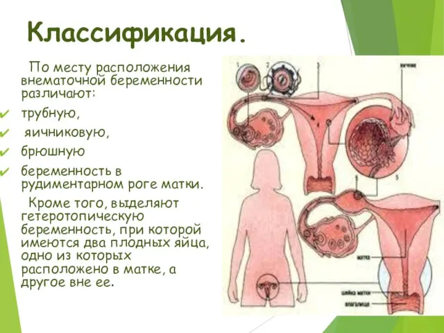 Классификация. По месту расположения внематочной беременности различают: трубную, яичниковую, брюшную