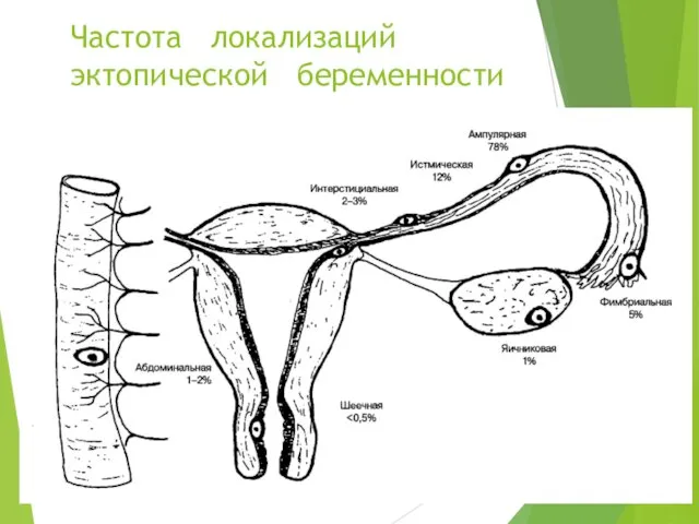 Частота локализаций эктопической беременности