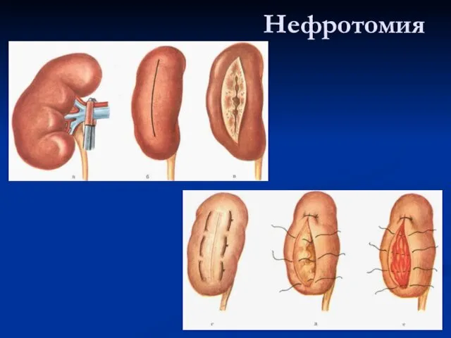Нефротомия
