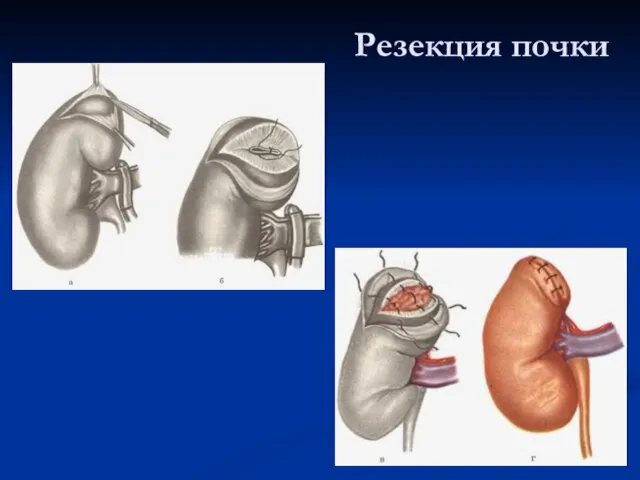 Резекция почки