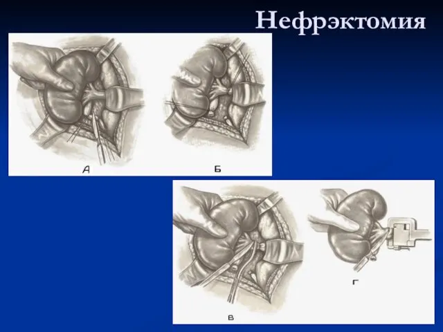 Нефрэктомия