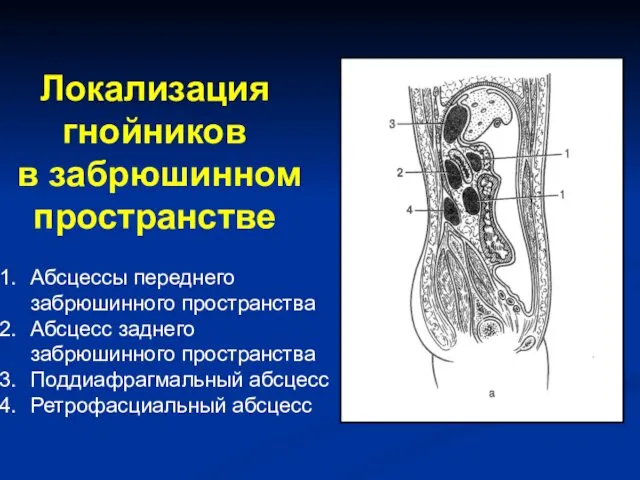 Локализация гнойников в забрюшинном пространстве Абсцессы переднего забрюшинного пространства Абсцесс