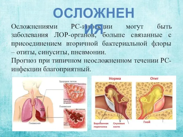 Осложнениями РС-инфекции могут быть заболевания ЛОР-органов, больше связанные с присоединением