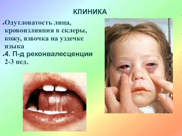 КЛИНИКА Одутловатость лица, кровоизлияния в склеры, кожу, язвочка на уздечке языка 4. П-д реконвалесценции 2-3 нед.