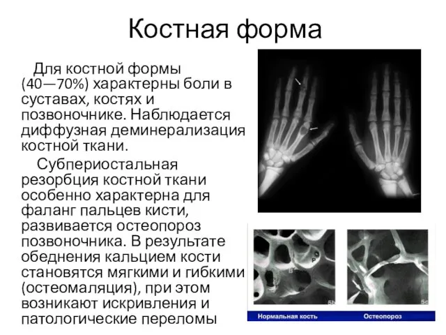 Костная форма Для костной формы (40—70%) характерны боли в суставах,