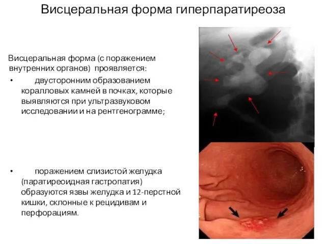 Висцеральная форма гиперпаратиреоза Висцеральная форма (с поражением внутренних органов) проявляется: