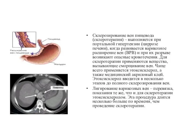 Склерозирование вен пищевода (склеротерапия) – выполняется при портальной гипертензии (циррозе печени), когда развивается