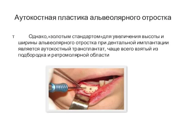 Аутокостная пластика альвеолярного отростка т Однако,»золотым стандартом»для увеличения высоты и