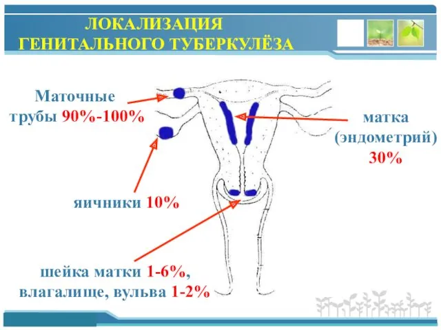 ЛОКАЛИЗАЦИЯ ГЕНИТАЛЬНОГО ТУБЕРКУЛЁЗА Маточные трубы 90%-100% матка (эндометрий) 30% яичники