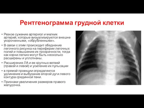 Рентгенограмма грудной клетки Резкое сужение артериол и мелких артерий, которые