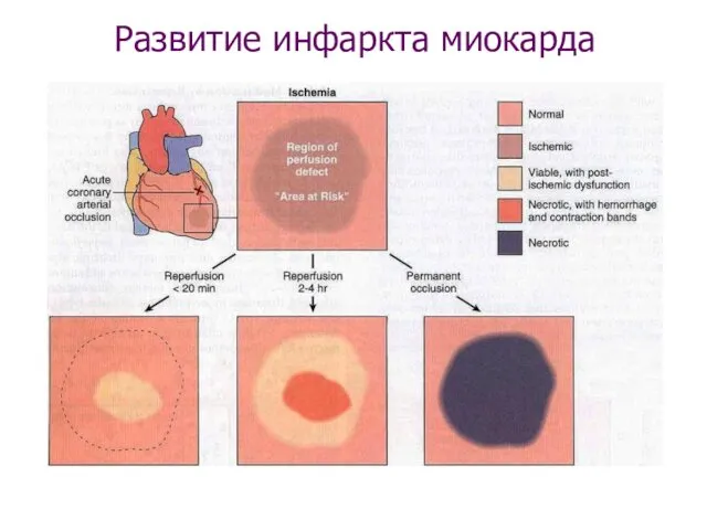 Развитие инфаркта миокарда