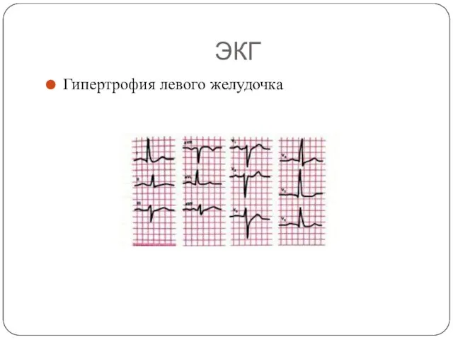 ЭКГ Гипертрофия левого желудочка