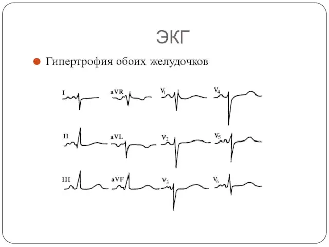 ЭКГ Гипертрофия обоих желудочков