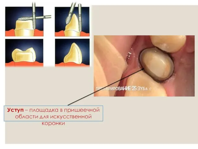 Уступ – площадка в пришеечной области для искусственной коронки