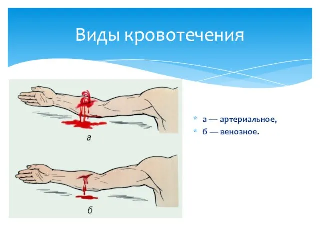 а — артериальное, б — венозное. Виды кровотечения