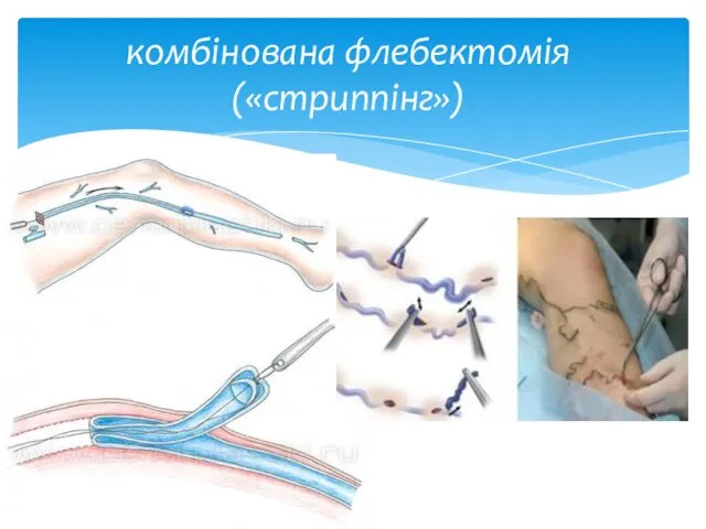 комбінована флебектомія («стриппінг»)