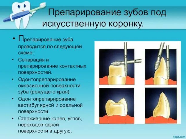 Препарирование зубов под искусственную коронку. Препарирование зуба проводится по следующей
