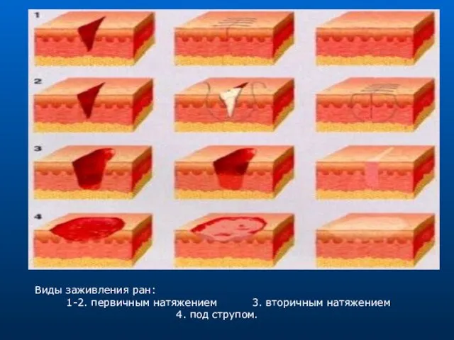 Виды заживления ран: 1-2. первичным натяжением 3. вторичным натяжением 4. под струпом.