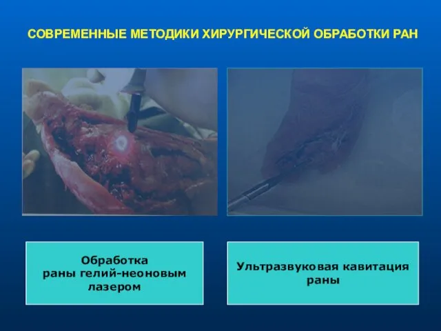 СОВРЕМЕННЫЕ МЕТОДИКИ ХИРУРГИЧЕСКОЙ ОБРАБОТКИ РАН Обработка раны гелий-неоновым лазером Ультразвуковая кавитация раны