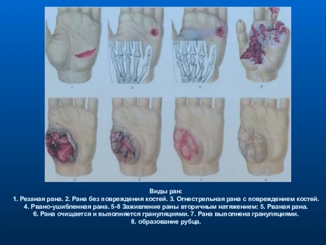 Виды ран: 1. Резаная рана. 2. Рана без повреждения костей.
