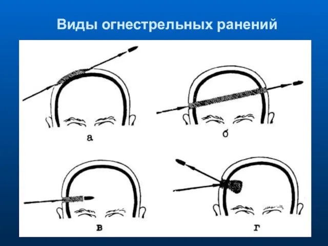 Виды огнестрельных ранений