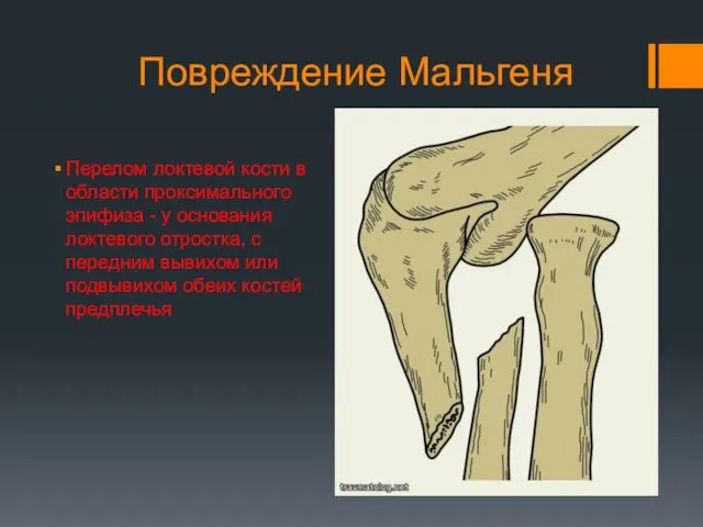 Повреждение Мальгеня Перелом локтевой кости в области проксимального эпифиза -