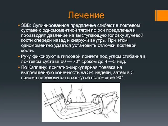 Лечение ЗВВ: Супинированное предплечье сгибают в локтевом суставе с одномоментной