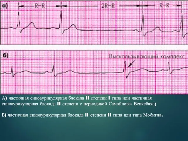 А) частичная синоаурикулярная блокада II степени I типа или частичная