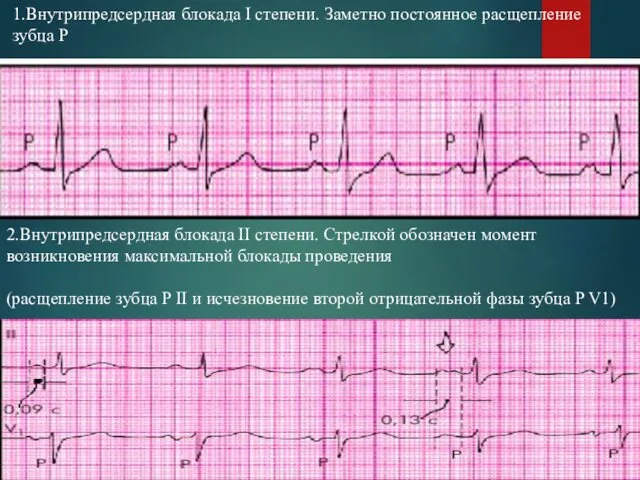 1.Внутрипредсердная блокада I степени. Заметно постоянное расщепление зубца Р 2.Внутрипредсердная