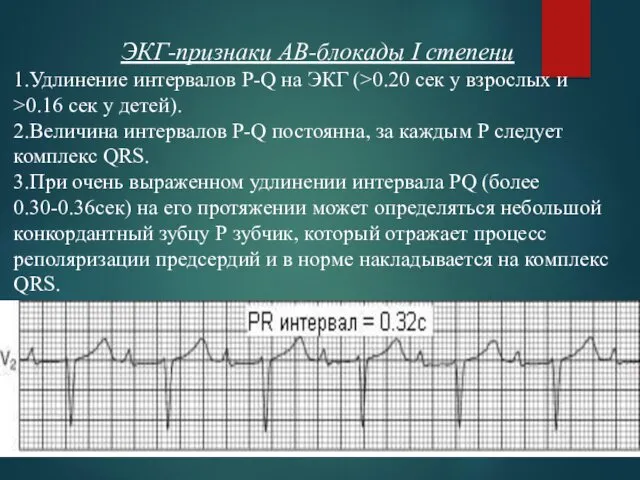 ЭКГ-признаки АВ-блокады I степени 1.Удлинение интервалов P-Q на ЭКГ (>0.20