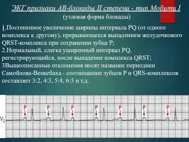 ЭКГ признаки АВ-блокады II степени - тип Мобитц I 1.