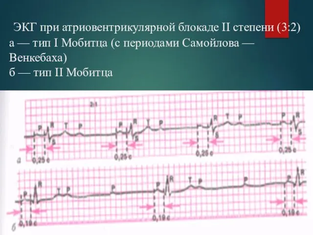 ЭКГ при атриовентрикулярной блокаде II степени (3:2) а — тип