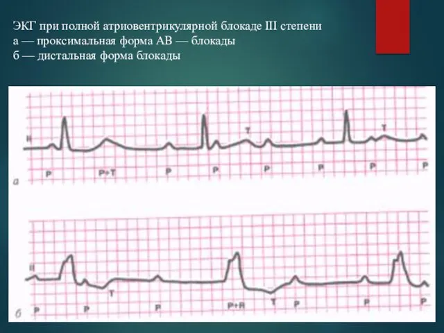 ЭКГ при полной атриовентрикулярной блокаде III степени а — проксимальная