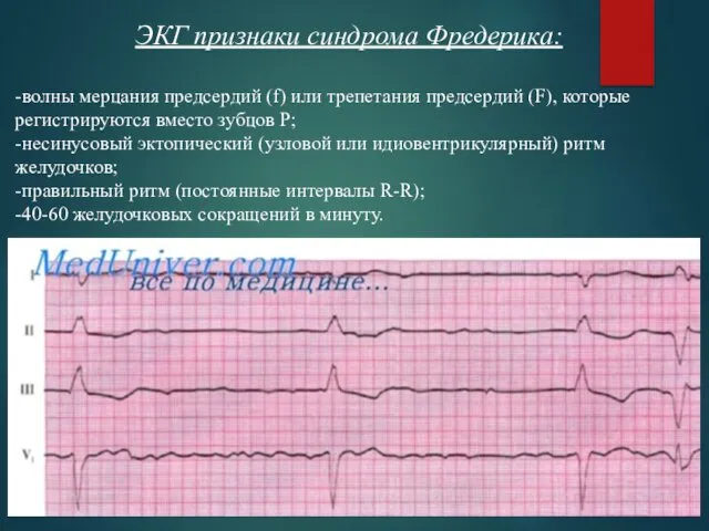 ЭКГ признаки синдрома Фредерика: -волны мерцания предсердий (f) или трепетания