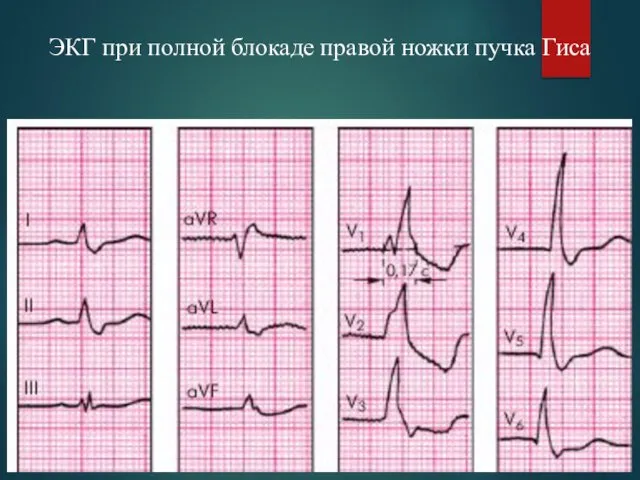 ЭКГ при полной блокаде правой ножки пучка Гиса