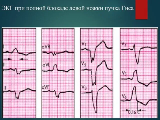 ЭКГ при полной блокаде левой ножки пучка Гиса