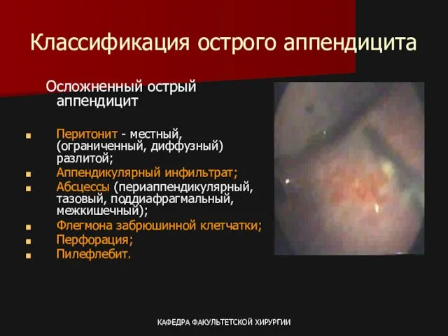 КАФЕДРА ФАКУЛЬТЕТСКОЙ ХИРУРГИИ Классификация острого аппендицита Осложненный острый аппендицит Перитонит