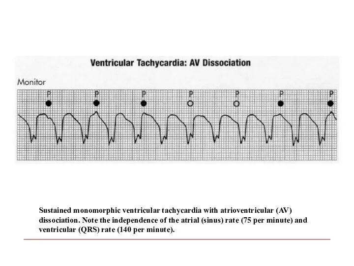 Sustained monomorphic ventricular tachycardia with atrioventricular (AV) dissociation. Note the