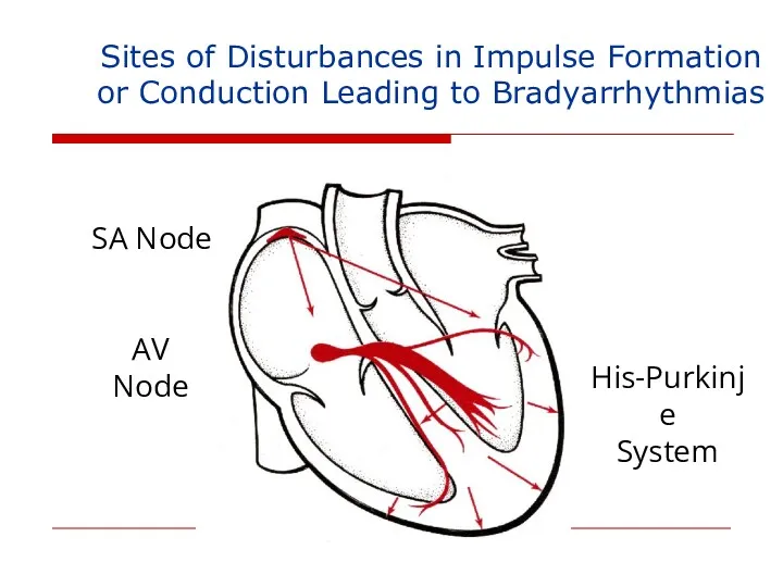 Sites of Disturbances in Impulse Formation or Conduction Leading to