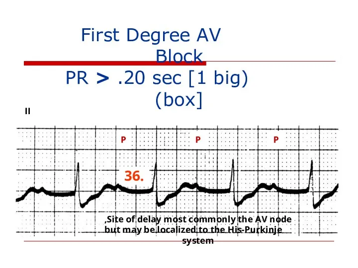 First Degree AV Block (PR > .20 sec [1 big