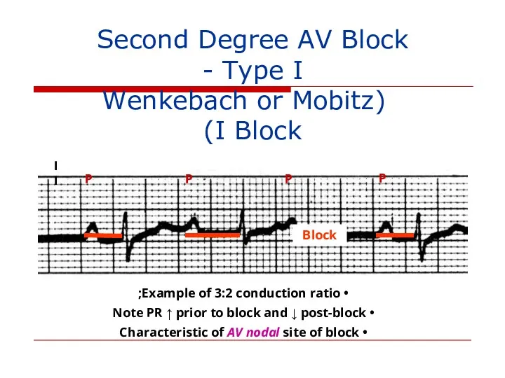 Second Degree AV Block - Type I (Wenkebach or Mobitz