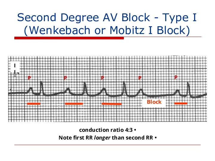 II Block P P P P P 4:3 conduction ratio